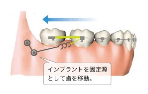 インプラント矯正